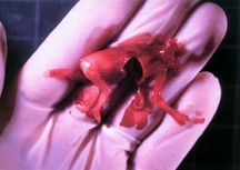 D & C Abortion Picture