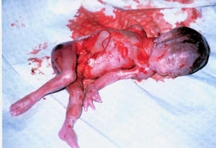 D & E Abortion Picture